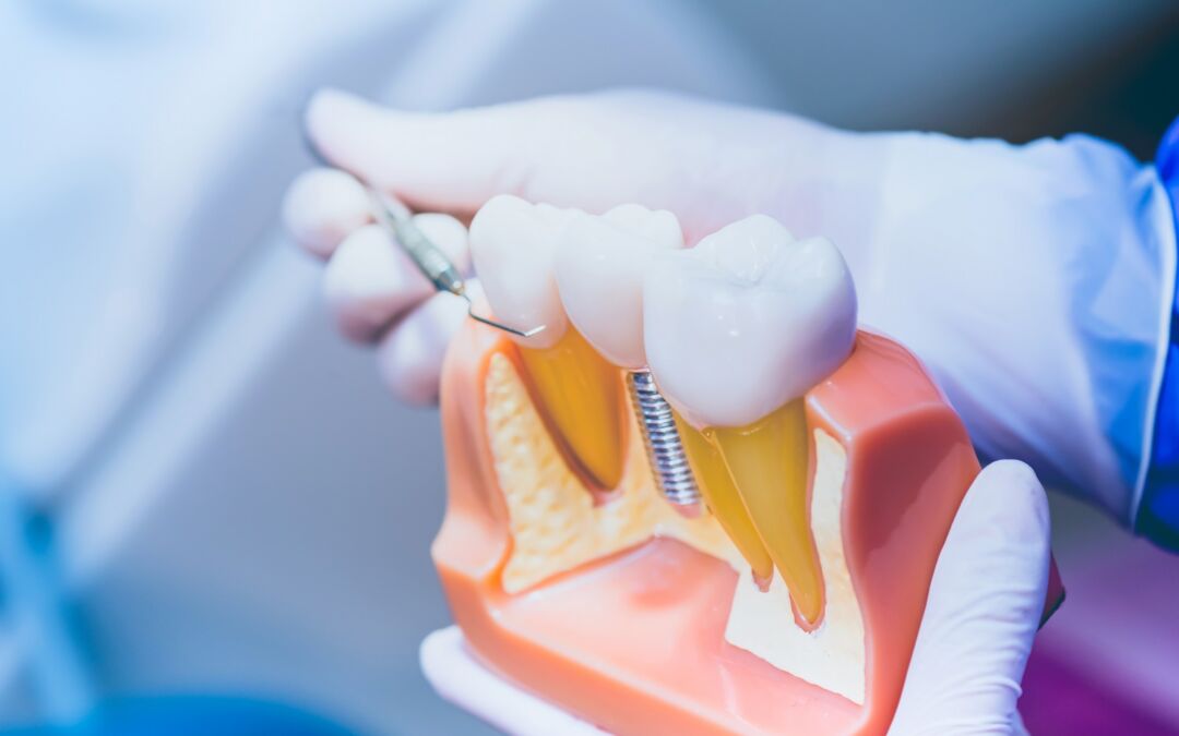 Dental Implant Healing Stages