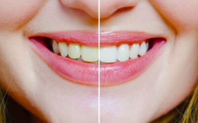 Professional Teeth Whitening vs. At-Home Teeth Whitening