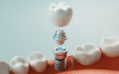 Are Dental Implants Right for Me?