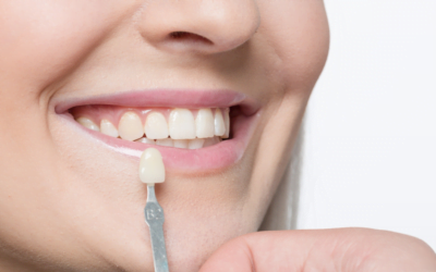 Crowns vs Veneers: Which Option is Right for You?