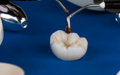 What Are Dental Inlays & Onlays?