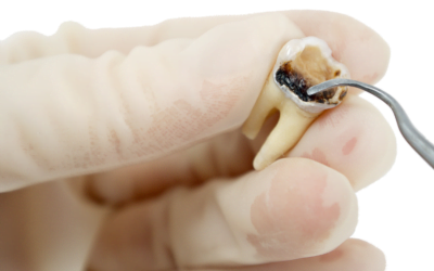 How to Get Rid of Cavities