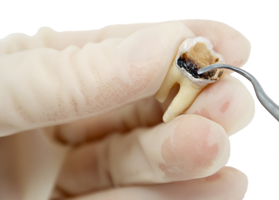 How to Get Rid of Cavities