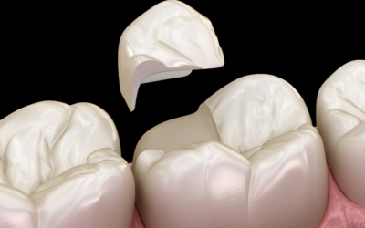 Teeth Bonding: What You Need to Know
