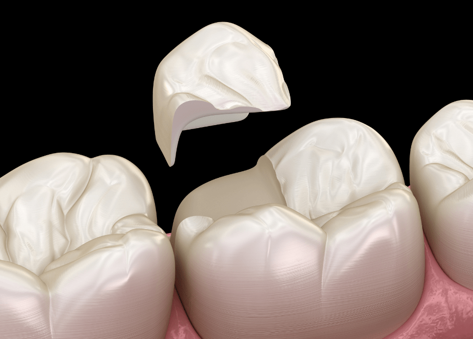 Teeth Bonding: What You Need to Know