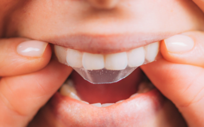 Do Teeth Whitening Strips Work?