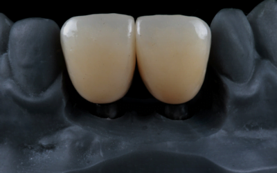 What Is a Dental Crown? Everything You Need to Know