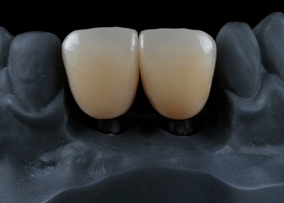 What Is a Dental Crown? Everything You Need to Know
