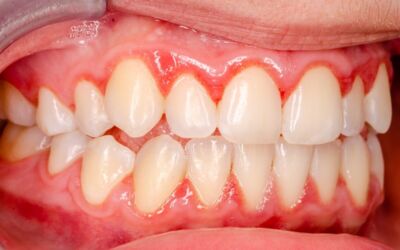 How to Cure Gingivitis in a Week
