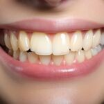 Tooth Discolouration