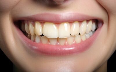 Tooth Discolouration: Causes, Treatment & Prevention
