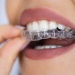 Invisalign