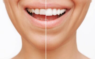 Veneers or Bonding: Which Cosmetic Solution Suits You?