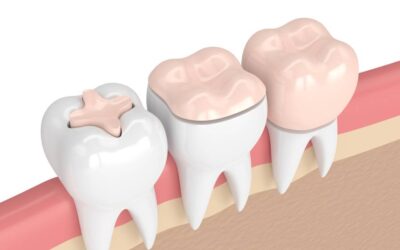 Inlays & Onlays—What Are They and When Are They Used?