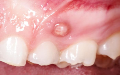 What Causes a Small White Bump on Gums Near a Toothache?
